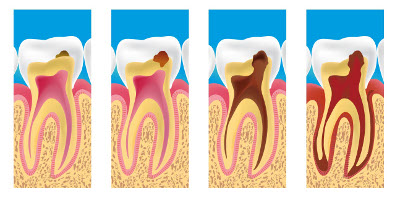 Les caries à Angers